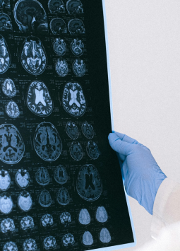 Aunque el covid-19 se considera una enfermedad respiratoria, nuevas investigaciones revelan que sus secuelas podrían afectar directamente al cerebro, con vínculos preocupantes con el Alzheimer.